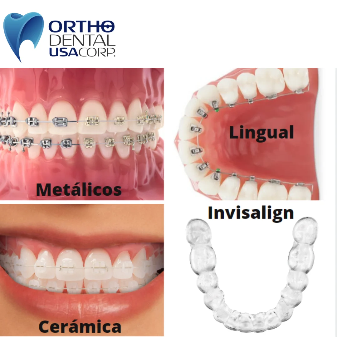 The Process: Regular adjustment appointments every 4–8 weeks for braces or new Invisalign trays every 1–2 weeks.