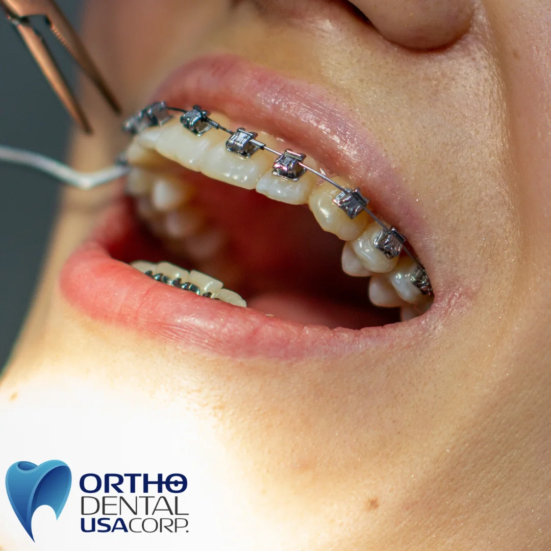 For Braces: Brackets are bonded to the teeth and archwires are placed. This process typically takes 1 to 2 hours.

For Invisalign: You will receive your first set of clear aligners and instructions on how to wear them for 22+ hours a day.

What to Expect: Mild soreness for a few days as your teeth adjust. There is a slight learning curve when eating and speaking, but don't worry—you’re officially on your way to a new smile!