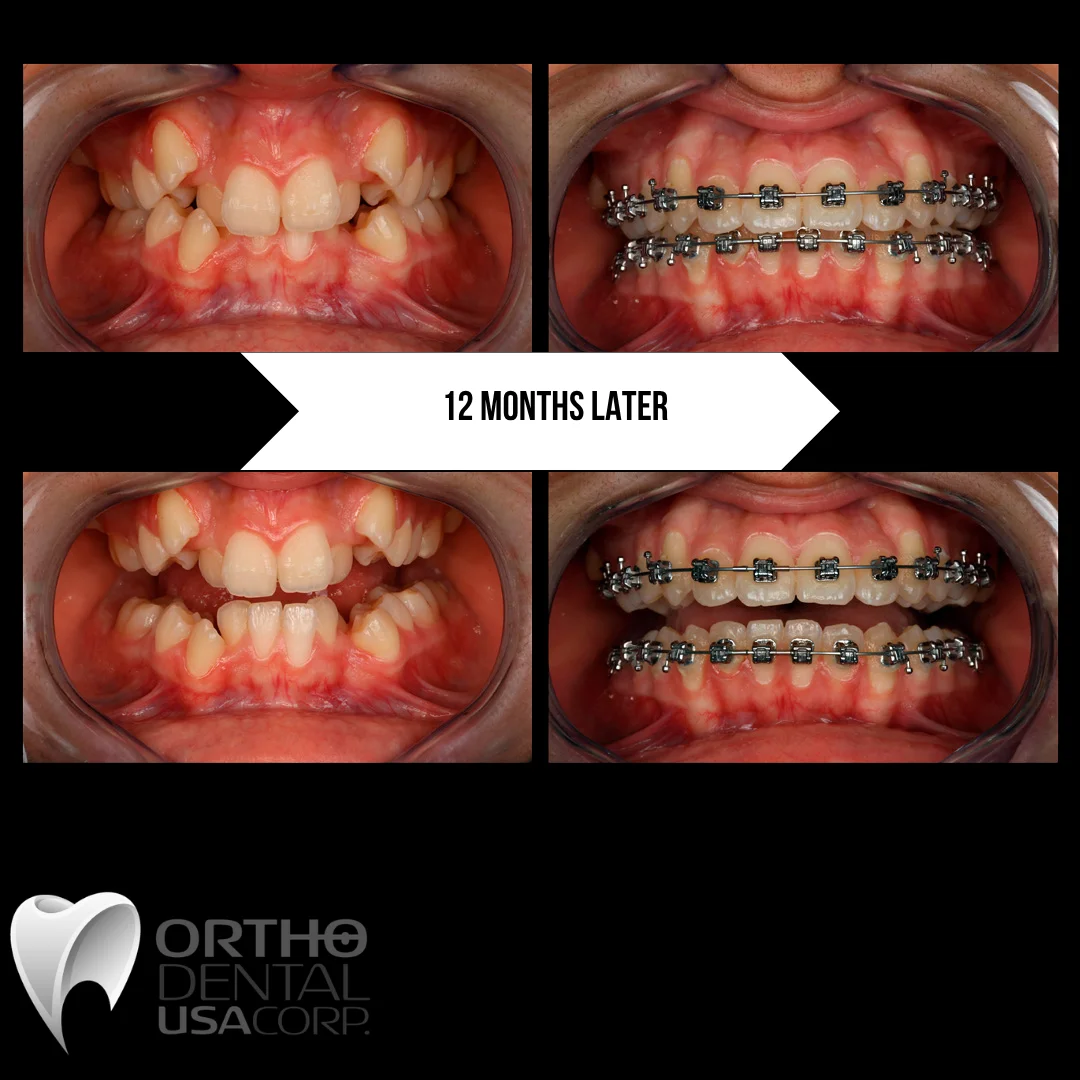 The Process: Final adjustments are made to ensure a proper bite. Brackets are then removed (debonding), and final scans are taken for your custom retainer.

The Reward: The incredible feeling of smooth teeth and a perfectly aligned smile!