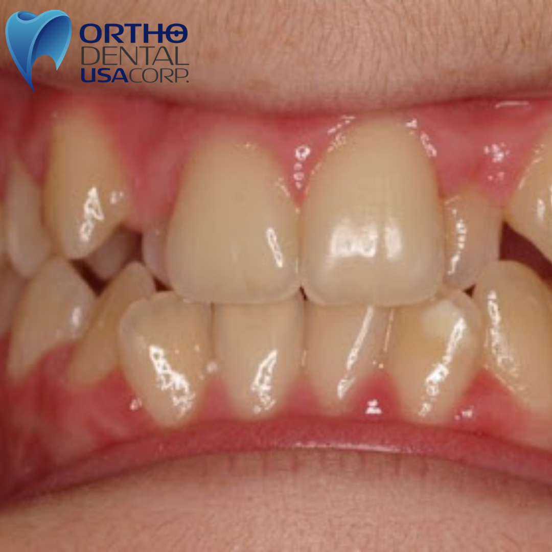 Missing Lateral Incisors
