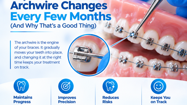 orthodontic archwire being placed into bracket slots on a dental model