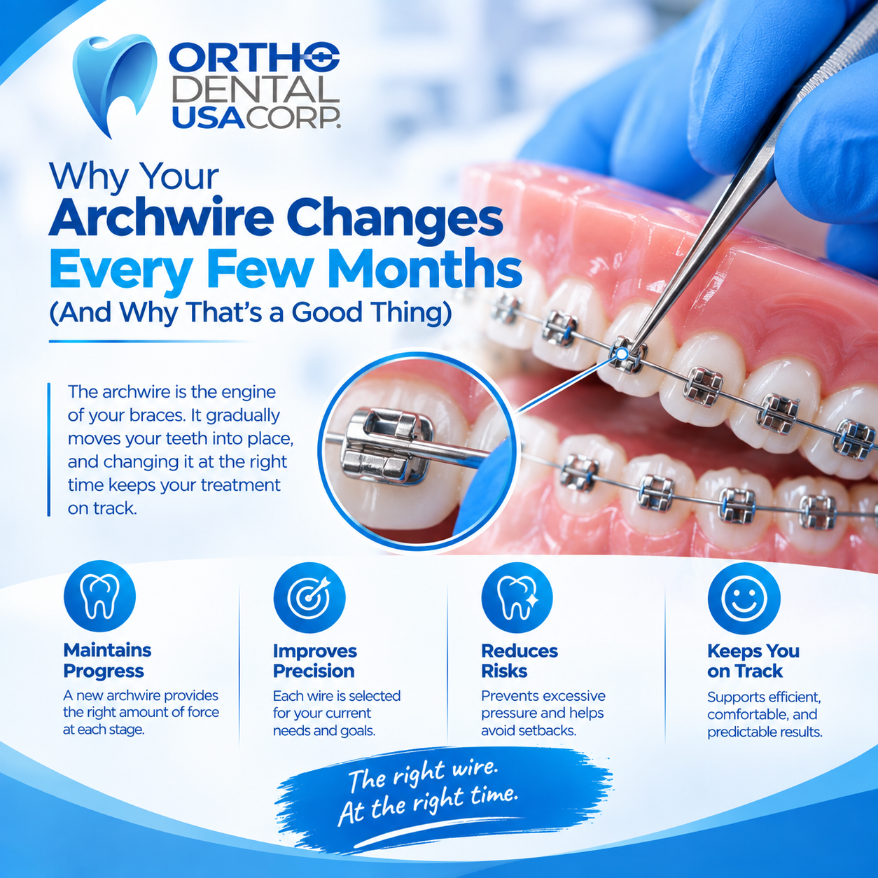 orthodontic archwire being placed into bracket slots on a dental model